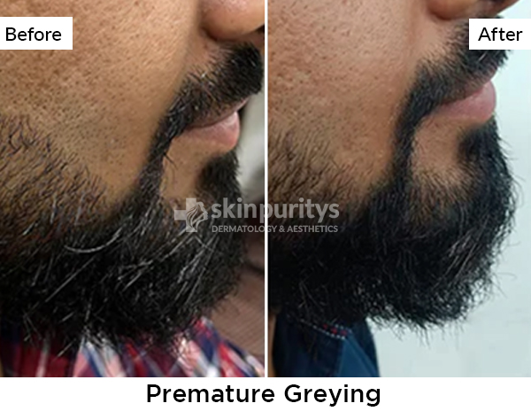 Premature Greying results